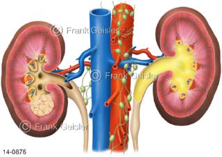 Schnitt durch Nieren, Nierenzellkarzinom, obstruktive Uropathie Harnstau