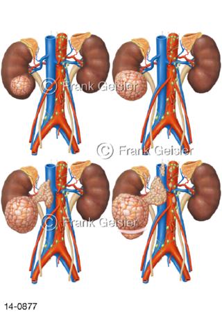 Nieren mit Nierenkrebs Nierenzellkarzinom, Formen Nierenzelltumore