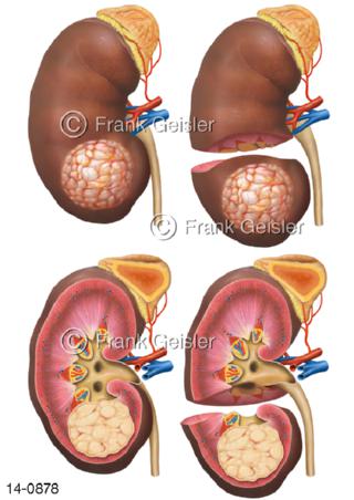 OP Nierenkrebs Nierenzellkarzinom Nierenzelltumor