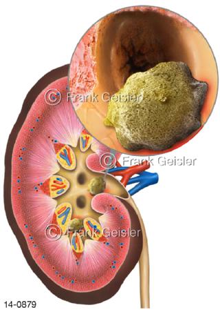 Niere mit Nierenstein im Nierenbecken