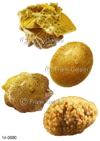 Formen Nierensteine Harnsteine