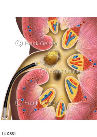 Nierenbecken, flexible Ureterorenoskopie Steinextraktion