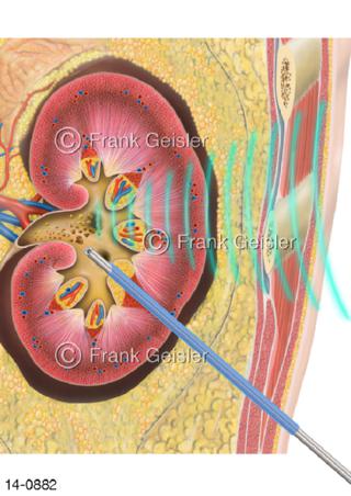 Niere, Nephrolithotomie Steinextraktion