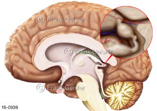 Lage der Hormondrüse Epiphyse Zirbeldrüse im ZNS Gehirn