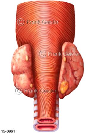 Schilddrüse Nebenschilddrüsen Parathyroid glands mit Adenom dorsal