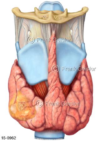 Schilddrüse vorn, Schilddrüsenkrebs Schilddrüsenkarzinom