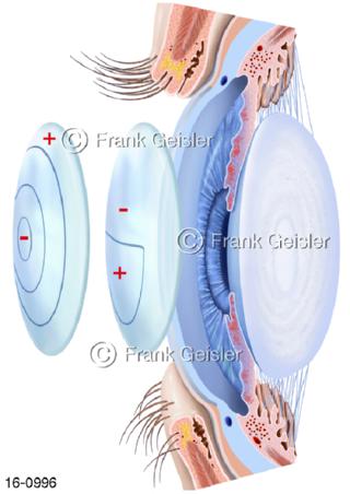 Auge, Augenlinse Linse Bifokal Kontaktlinsen