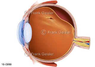Sinnesorgan Auge Augapfel, Glaskörper Glaskörperabhebung mit Loch