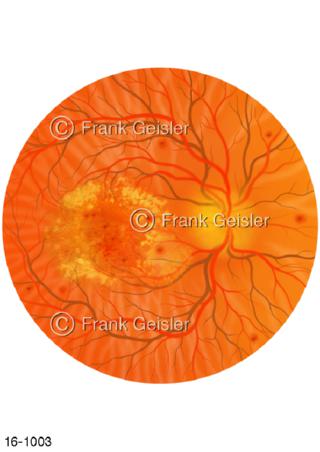 Augenhintergrund, Makula bei Diabetes mellitus