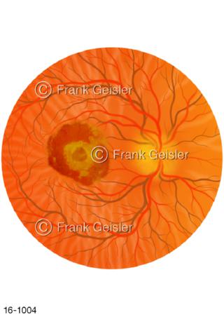Augenhintergrund Makula, feuchte Makuladegeneration