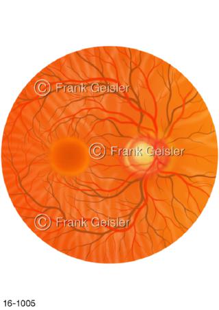 Augenhintergrund Makula, Grüner Star Glaukom