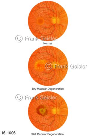 Augenhintergrund, Makula Veränderungen