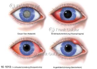 Auge Augapfel mit Augenerkrankungen Katarakt Hyposphagma Konjunktivitis Gerstenkorn