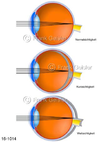 Auge Augapfel mit Fehlsichtigkeit kurzsichtig weitsichtig