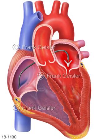 Herz Mitralklappe Mitraklappeninsuffizienz