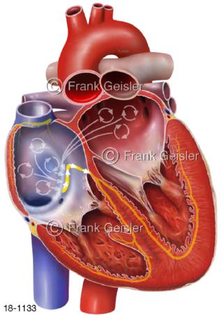 Herz Vorhofflimmern Atrium, Herzrhythmusstörung Sinusknoten