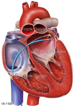 Vorhofflimmern Herz, Katheterablation