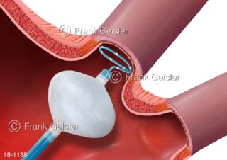 Herz Vorhofflimmer, VHF-Ablation, Kryotherapie Kryoablation linker Vorhof, Lungenvenen werden isoliert
