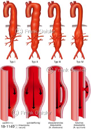 Aorta Aneurysma Formen, Aortenaneurysma