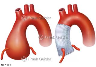 Aorta Aortenbulbus, Aortenwurzelerweiterung und Aortenersatz Gefäßstütze Stent