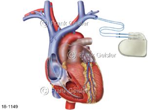 Herzerkrankung, Herz mit Defibrillator Schockgeber beim Erkennen von Herzrhythmusstörungen