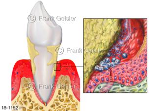Parodontitis Parodontose Zahntasche, durch Bakterien verursachte chronische Entzündung Zahnhalteapparat