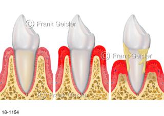 Erkrankungen Zahnfleisch, Gingivitis und Parodontitis, Entzündung Zahnhalteapparat