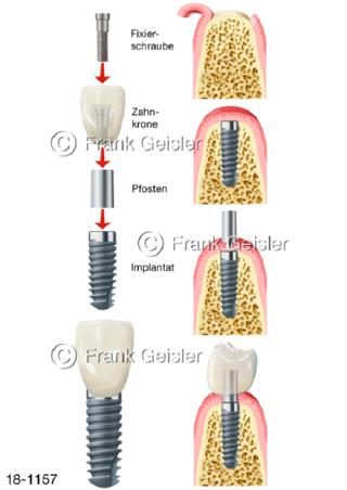 Zahnimplantation Zahnimplantat Zahn