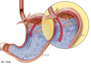 Sodbrennen Reflux Refluxkrankheit Magen Speiseröhre, Rückfluss saurer Mageninhalt