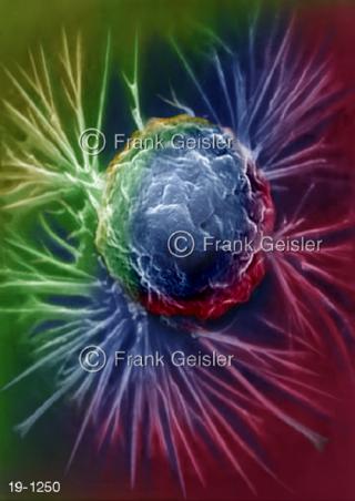 Krebs Tumorzelle Krebszelle Krebsgewebe