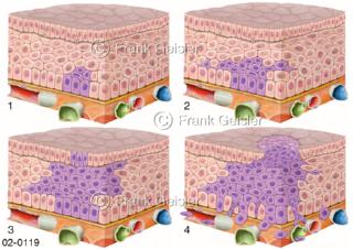 Epithelgewebe, Karzinogenese bei Krebs