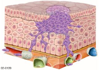 Karzinom mit Tumorzellen in Epithelgewebe