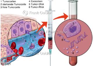  Diagnostik Tumorzellen im Blut, zirkulierende Tumorzellen (CTCs) oder deren DNA (ctDNA)