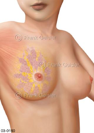 Brust Brustdruese, Drüsenlappen mit Milchdrüsen