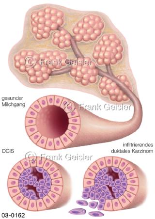 Brust, Brustdruese, Milchgang erkrankt