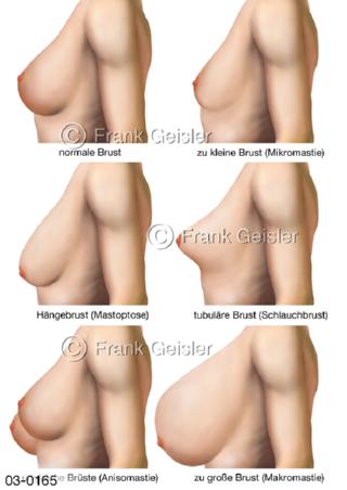 Brüste, Formen Brustformen der Brustdrüse