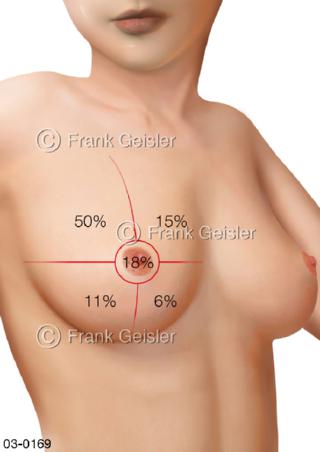 Brüste, Brust-Bereiche bei Brustkrebs