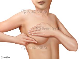 Krebsvorsorge, Abtasten nach Knoten in der Brustdrüse