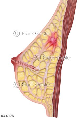 Brustkrebs in der Brust, Mammakarzinom mit Entzündung