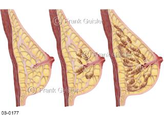 Brust, Brustdrüse mit Drüsengewebe normal und laktierend