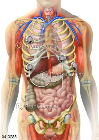 Organe und Port-A-Cath-System