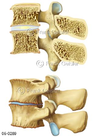 05-0289 Arthrose Lendenwirbel, degenerative Bandscheibe