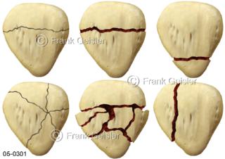 Kniescheibenbruch Kniefrakturen, Patellafrakturen der Kniescheibe