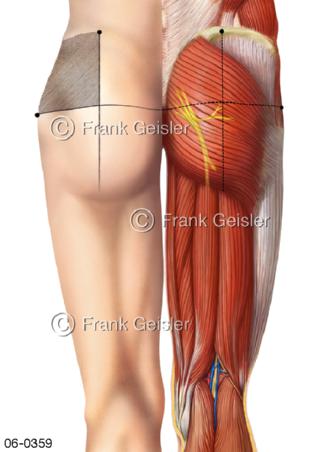 intramuskuläre Injektion Oberschenkel