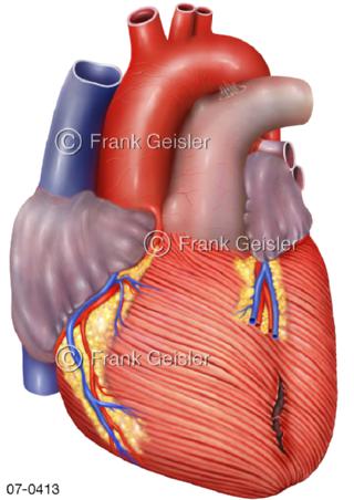 Herz, Herzruptur Herzmuskelriss Myokard Herzmuskel