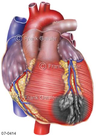 Herzinfarkt Myokardinfarkt Vorderwandinfarkt