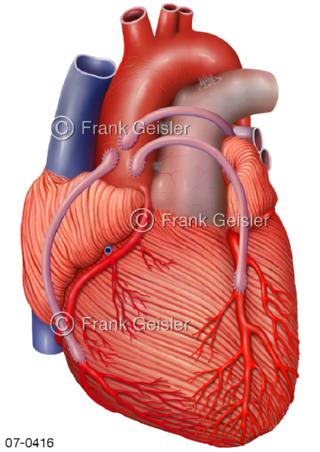 Herz, Bypass Koronargefäße Koronarien Herzkranzgefäße