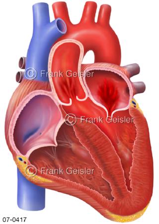 Herz, HOCM Obstruktion, Verdickung Herzmuskulatur