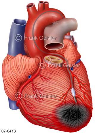 Herz, Herzinfarkt Myokardinfarkt Stammzeltherapie Koronarinjektion