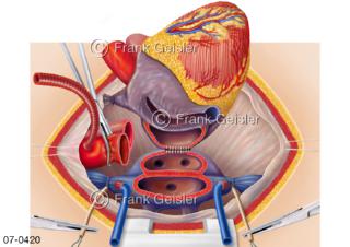 Herztransplantation, Transplantation Herz, OP Phase 2